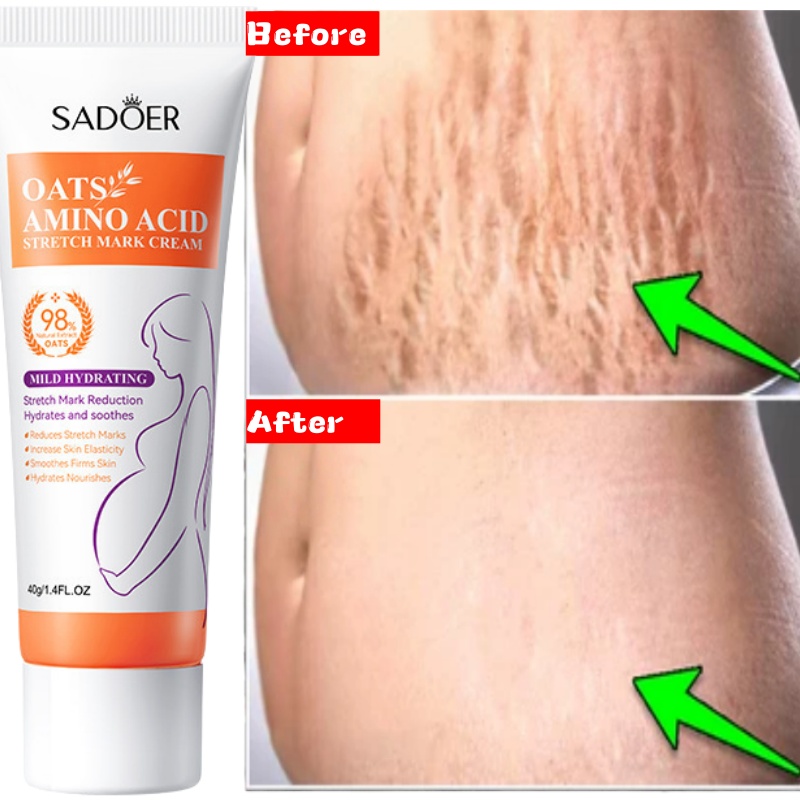 Skincare Oat - Dehnungsstreifen, dauerhafte Entfernungscreme, beseitigt Körper, Bauch,